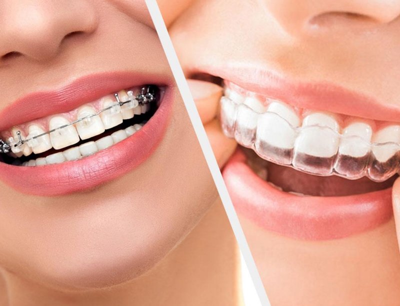 Patient before braces treatment